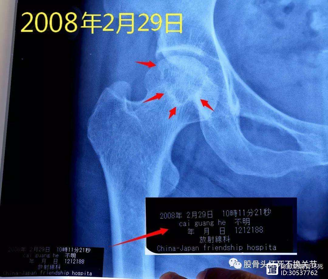 六安人工骨头医保报销多少(人工骨头医保报销多少比例)